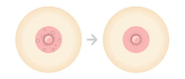 モントゴメリー腺除去