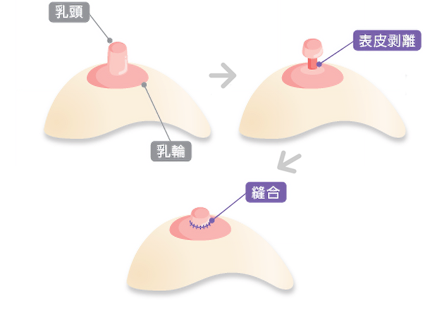乳頭縮小・乳輪縮小